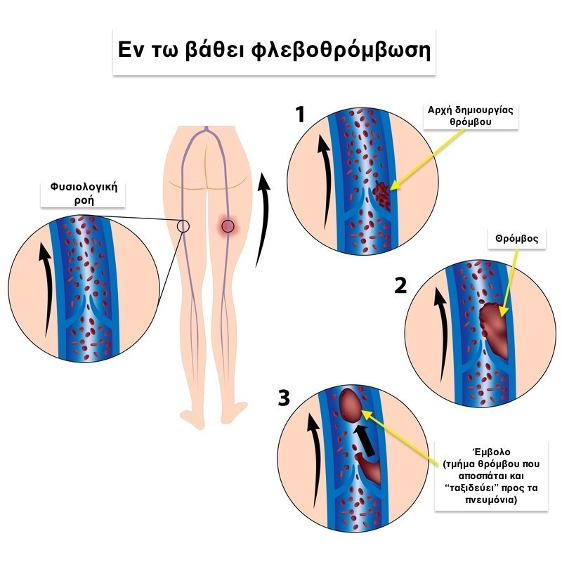 thromvosi